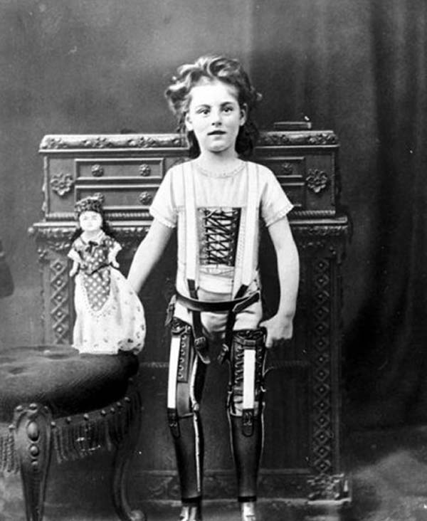 jeune fille avec des prothÃƒÂ¨ses artificielles, en 1898